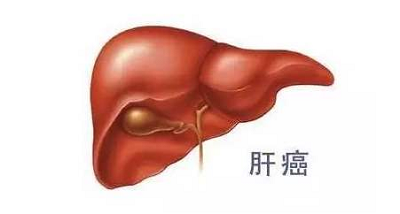 广州御生堂中医:如何才能发现自己有肝癌