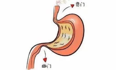 广州肿瘤科医院|感染幽门螺杆菌=得了胃癌?看中医如何挽回!