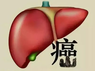 广州中医肿瘤医师:肝癌的这些症状你一定要知道