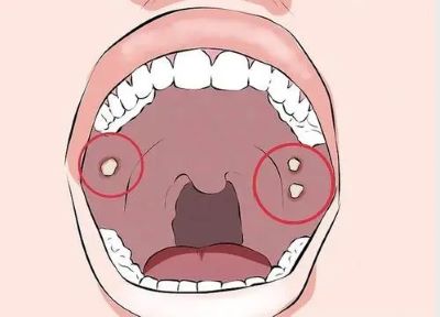 广州御生堂老中医:预防口腔癌比较有效的方法是什么呢