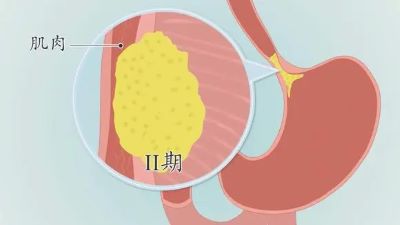 广州中医肿瘤专家:这些都是贲门癌的症状,看看中医又是怎么治疗的