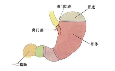 广州治疗贲门癌好的老中医:打嗝不止要注意有可能是贲门癌在"作祟"