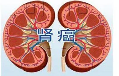 　　肾癌在我们生活中的出现频率已经越来越高了，如何预防成为了大多数人都十分关注的事情。不过预防肾癌并不复杂，只要在生活中注意，就可以很好的预防肾癌了。下面就有请医师来给大家介绍吧。  　　肾癌在生活中要怎么预防？  　　1、加强锻炼：保持一个好的体质对身体而言是非常重要的，它不仅能够预防疾病的发生，还能增强机体的免疫抵抗的能力。坚持做好各种锻炼，对身心都有一种促进作用，还能培养人的情操，与此同时还能保持身体的健康，防止肥胖和瘦弱，有一个好的身材是每个人的梦想。  　　2、体检：日常生活中，应该定期或不定期的进行全面的身体检查是非常必要的，做好各种检查，对自己来说是一种责任。平日里经常进行自我检查，也能够帮助我们及时的发现疾病，并且能够发现身体所需要的物质，并予以补充。身体的健康能够让我们有效的远离疾病的缠扰。防止疾病的恶化和病情的延发。  　　3、在合理饮食的同时，一定要保证食物的安全性，观察食物的保质日期，禁食已变质的食物，发霉的食物也应严格的避免。很多人饮食的口味较重，喜欢吃一些过咸、过辣的食物，对腌制的食物是情有独钟，像咸菜、腌肉等，应避免过多的摄入。  　　4、生活在一个良好的环境下，避免污染，避免有毒物质的侵入，在室内的时候，应常通风，保证空气的对流。对化学性致癌的物质进行一定的了解，避免与其长时间接触，比如说铅化合物等，对疾病的预防非常有效。    　　肾癌的治疗方法  　　1、药物治疗  　　药物治疗即是中医的治疗方法，手术不能完全切除或已有转移的中晚期肾癌病人，可以采用一些内科治疗。能提高生存期间的生活质量。因此，临床上具有强大的意义。  　　2、免疫调节治疗  　　免疫治疗针对恶性肾癌，能够有效延长患者生存期、提高生活质量。与传统的治疗方法不同，免疫调节治疗主要是调动人体的天然消瘤能力，恢复机体内环境的平衡。  　　3、激素治疗  　　肾癌对激素有明显的依赖性，近年来的研究结果提示正常肾和肾癌组织中含有雄激素和孕激素受体，以及对黄体酮和睾丸酮抑制肿瘤生长的实验观察，导致了激素在肾癌治疗中的应用。激素对晚期肾癌患者能减轻症状和延长生存期方面确有较好的疗效，这可能与激素受体有关  　　4、肾癌中医治疗  　　治疗方法分为单纯性肾癌中医药消除肿瘤和治疗性肾癌中医药消除肿瘤，目前认为治疗性肾癌中医药消除肿瘤可以大大提高生存率。治疗性肾癌中医药消除肿瘤包括肾周围筋膜及其内容：肾周围脂肪、肾和肾上腺。肾癌中医治疗时应争取先结扎肾动脉和肾静脉，可以减少中医治疗中出血和可能引起的肿瘤扩散。肾癌是多血管肿瘤，常有大的侧枝静脉，中医治疗容易出血，且不易控制。因此，在较大肿瘤中医治疗时，可以在术前进行选择性肾动脉栓塞可引起剧烈疼痛、发热、肠麻痹、感染等，不应常规应用。