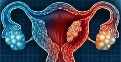 广州治疗子宫内膜癌老中医:这些坏习惯会导致子宫内膜癌的发生
