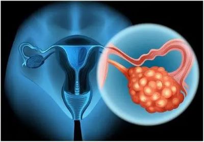广州中医肿瘤专家:你知道治疗卵巢癌比较好的方法吗