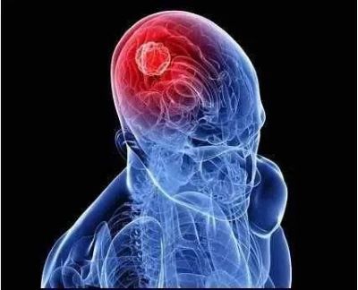 广州肿瘤老中医:脑胶质瘤是怎么回事?有什么好的预防脑瘤方法
