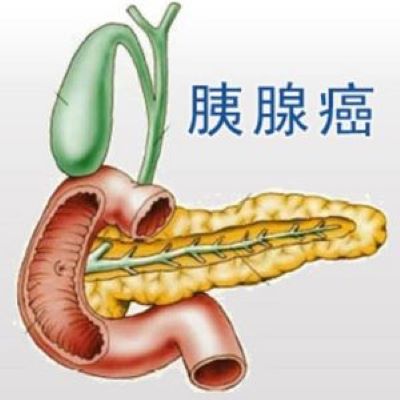 广州中医肿瘤专家张忠民:选择健康的生活方式才能预防胰腺癌