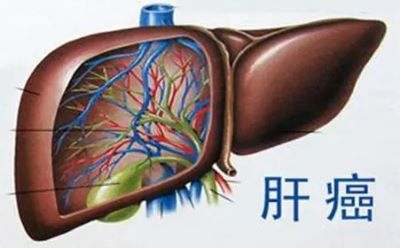 中医治疗肝癌还有这三大优势