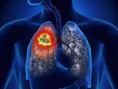 对于肺癌的复发,转移中医是如何治疗的？