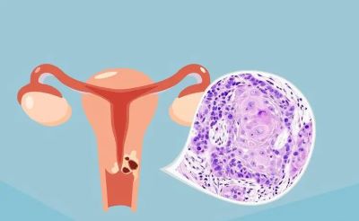 卵巢癌患上之后如何采取科学的中医治疗?