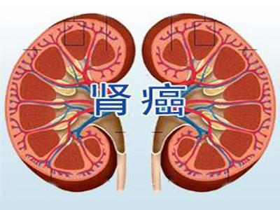 广州治疗肾癌厉害的老中医