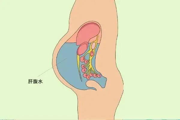 广州御和堂黄俊的评价：肝癌腹水的症状有哪些？