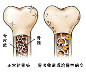 骨癌都有哪些症状表现？早发现早治疗