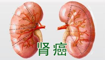 中医对于肾癌的认识，了解一下