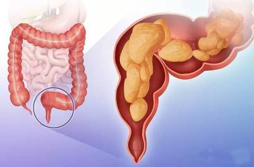 直肠癌有哪些症状表现？这4种症状较典型