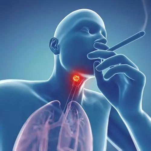 导致喉癌的病因是什么？主要是这7种原因造成的